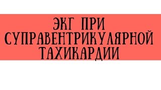 ЭКГ при синусовой тахикардии, фибрилляции и трепетании предсердий - meduniver.com