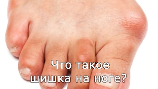 Что такое шишка на ноге?