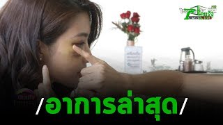 อุบัติเหตุเข้าฉากเป็นศพทำ ไอซ์ หวิดตาบอด | 04-11-62 | บันเทิงไทยรัฐ