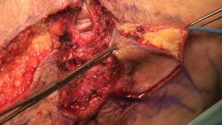 VULVAR RECONSTRUCTION WITH FLAP FOR CARCINOMA