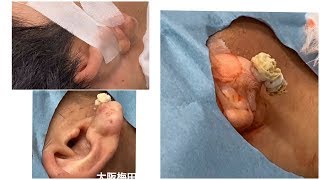 粉瘤　くりぬき法　大阪梅田形成外科粉瘤クリニック