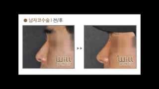 요구르트 윌이아닌 코잘하는곳 강남 윌에서 자연스럽게 성형하기