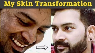 My Skin Transformation. How did I achieve a Healthy Skin Naturally