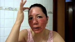 Laser CO2 fracionado - Minha Experiência