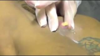 Выдавливание гигантского прыща на спине/Squeezing big pimple
