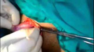 Orchidectomy - Removal of Testis in an adult with undescended testis