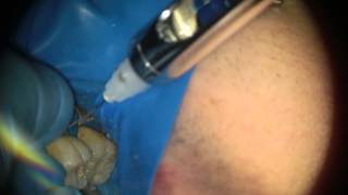 Интрасептальная анестезия. Intraseptal anesthesia.