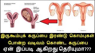 இருகூம்புக் கருப்பை இரண்டு கொம்புகள் போன்ற வடிவம் கொண்ட கருப்பை ஏன் இப்படி ஆகிறது தெரியுமா