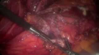 Laparoscopic Boari flap