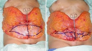 Abdominoplastia TULUA detalles de técnica para cirujanos plásticos
