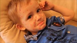 ИГРА В ДОКТОРА! Малыш заболел ВЕТРЯНКОЙ Делаем УКОЛ Видео для детей Chickenpox Playing Doctor