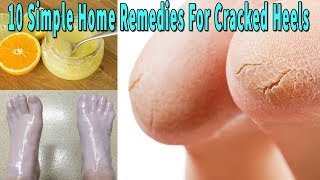 10 Simple Home Remedies For Cracked Heels -  Natural health Cures