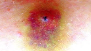 КАК ВЫГЛЯДЯТ УКУСЫ ПИЯВКИ, ПОСТПРИСТАВОЧНАЯ РЕАКЦИЯ ПОСЛЕ УКУСА ПИЯВКИ, СПРЕЙ ПИЯВИТ