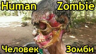 Человек-Зомби (люди-зомби) или некротический фасциит (Human Zombie - Necrotizing Fasciitis)
