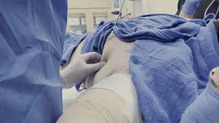 Adding LOWER ABS‼️ OHIO MALE, VaserLipo Gyno CHEST & ABS Contouring By Dr. Lebowitz, Long Island, NY