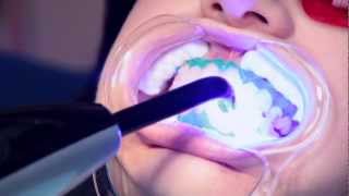 EZ Pro Whitening System (visit www.advanceddentalcarela.com) up to 8 shades in 1 visit!