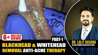 BLACKHEAD EXTRACTION WITH COTTON BUDS PART - 3