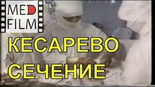 Кесарево сечение - экстраперитонеальное © Extraperitoneal cesarean section