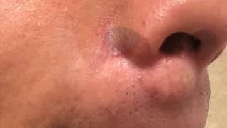 LIP SEBACEOUS CYST REMOVAL
