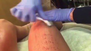 Tighten Sagging Skin after Weightloss