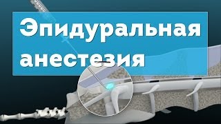 Эпидуральная анестезия. Epidural Anesthesia 3D