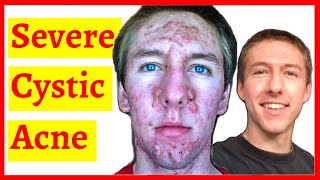 Cystic Acne Skin Clearing Transformation - 10 Month Timelapse