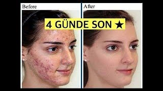 Sivilce ve Cilt Lekelerinden 4 GÜNDE Nasıl Kurtuldum?
