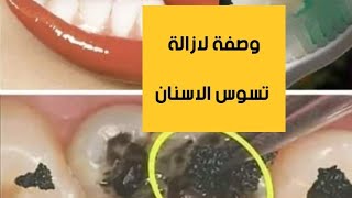وصفة للتخلص نهائي من تسوس الاسنان والجير المتراكم?جربي وشوفي بنفسك?