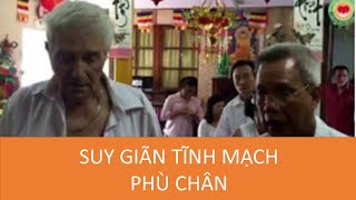 Làm sao chữa Suy giãn tĩnh mạch nhanh và hiệu quả nhất - Thập Chỉ Đạo (TCLT)