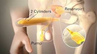 AMS 700 Penile Implant Education