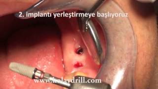 #Ameliyatsız, #Dikişsiz, #Flapless 2 #Diş #İmplant. Dt. Bülent Özçağatay
