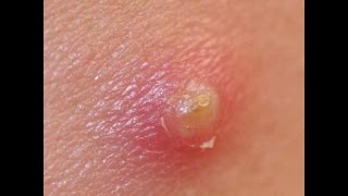 Выдавливание прыща/Squeezing pimple