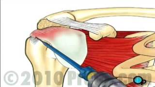 Rotator Cuff Repair - Arthroscopic Surgery