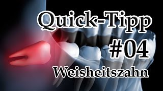 FAQ Weisheitszahn #04