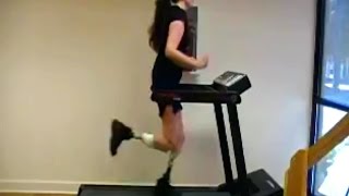 Double Amputee Beauty Success Walking