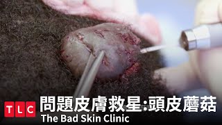 《問題皮膚救星》頭皮長蘑菇？沒想到摘下來像蟑螂｜TLC 旅遊生活頻道