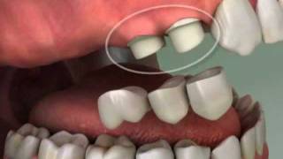 Cantilever Tooth Bridge - Roseville Dentist