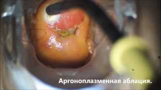 Лейкоплакия шейки матки. Аргоноплазменная аблация шейки матки.