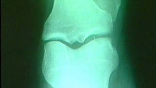 arthritis - knee pain - forever freedom