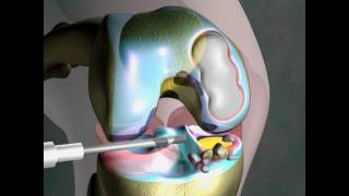 Arthrosurface knee patient testimonial bodybuilder