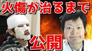 毎日まっとん第581回『顔を大火傷！！完全ドキュメンタリー』