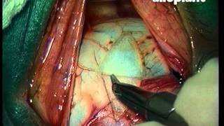 RV_opt_nerve