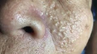 How To Remove Blackheads And Whiteheads On Face Easy #04