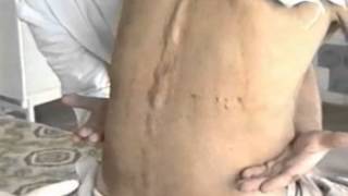 эпидуральная анестезия ( Epidural anesthesia )