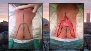Perineal urethrostomy (Перинеостома / Промежностная уретростомия)