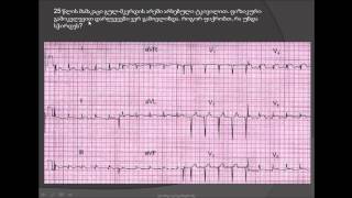 მწვავე პერიკარდიტი (გულის პერანგის ანთება) / ეკგ ინტერპრეტაცია / mwvave perikarditi