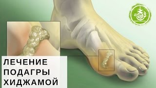 Лечение подагры хиджамой | Обучение Хиджаме