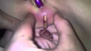 Epic Armpit Cyst | Must Watch
