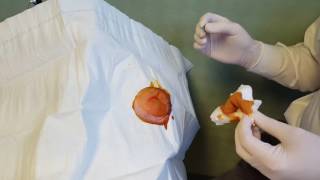 Dr. Kirby Demonstrates Verrucae Plantaris Needling Technique