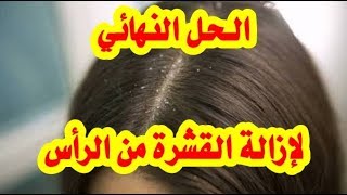وصفة طبيعية لتخلص من قشرة الشعر نهائيا